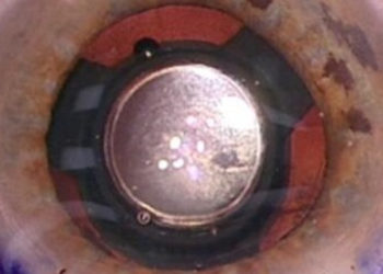 Impiantata in Puglia la prima lente telescopica per il recupero della vista