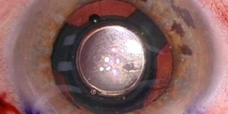 Impiantata in Puglia la prima lente telescopica per il recupero della vista