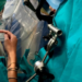 Policlinico di Bari, intervento di neurochirurgia pediatrica su un paziente sveglio